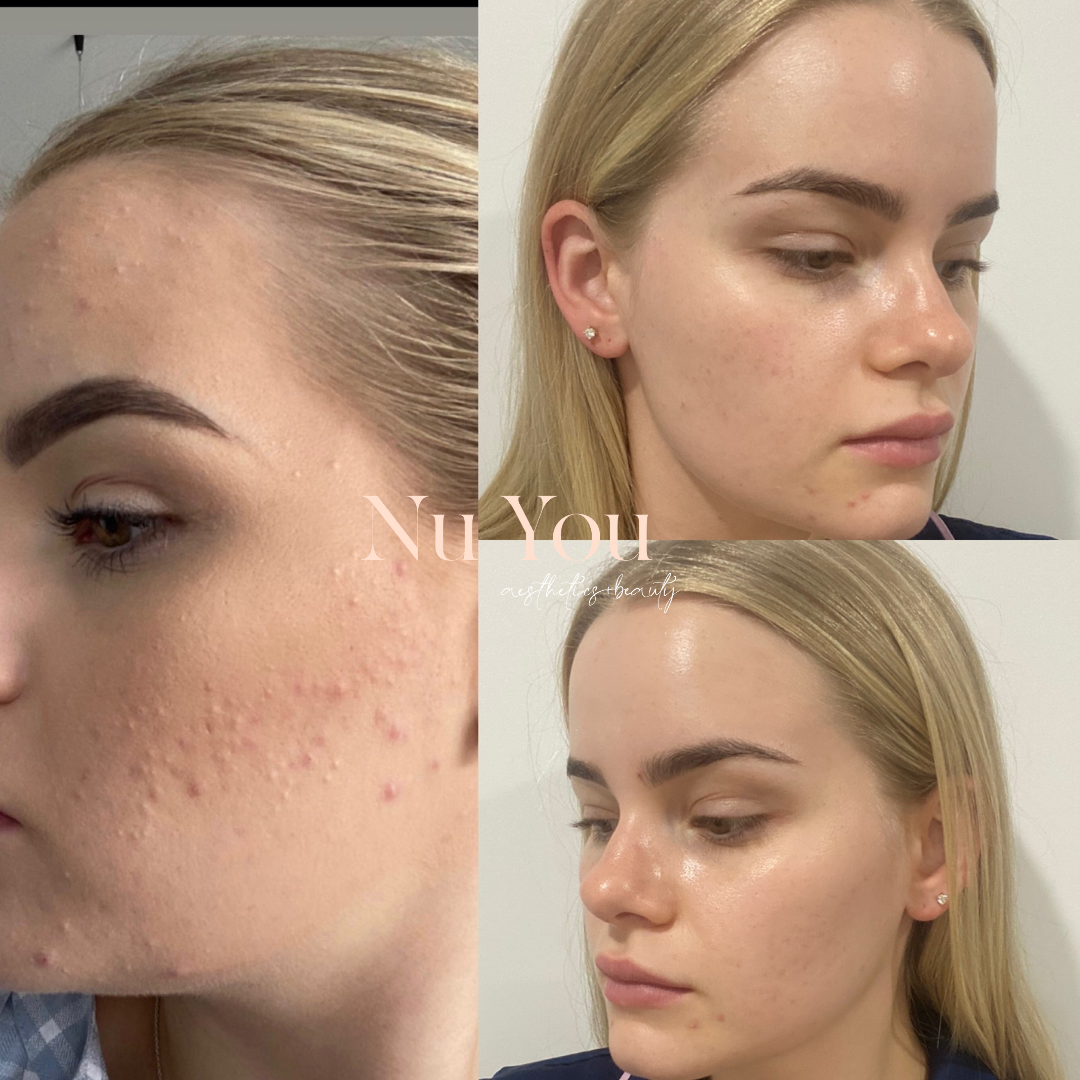 skin needling by Nu You Aesthetics & Beauty Clinic Mackay