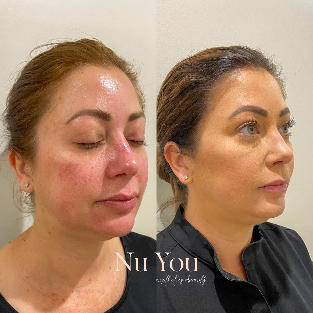 Cheek and chin filler and fat dissolver by Nu You Aesthetics & Beauty Clinic Mackay