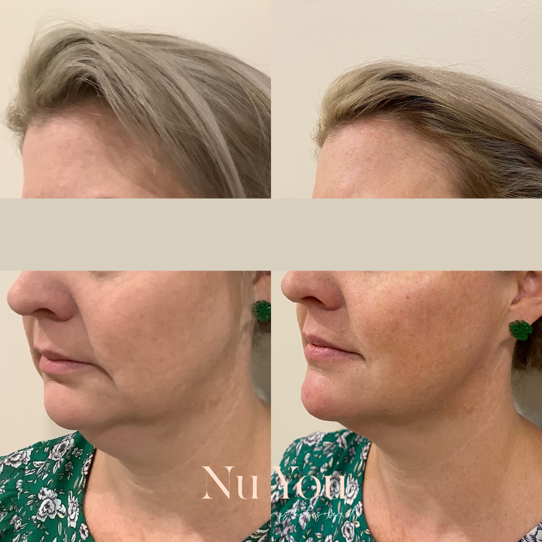 Chin and Cheek filler by Nu You Aesthetics & Beauty Clinic Mackay
