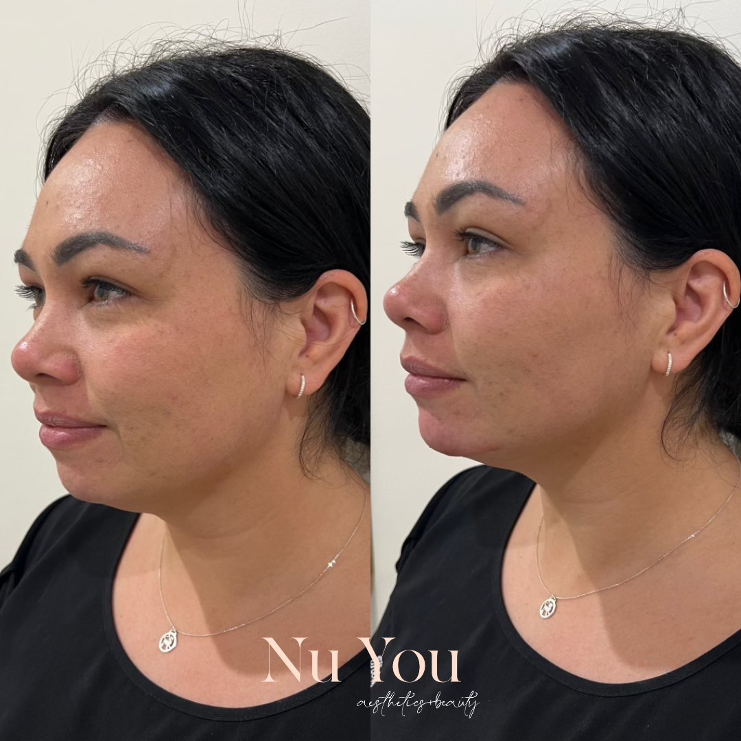 Chin Filler by Nu You Aesthetics & Beauty Clinic Mackay