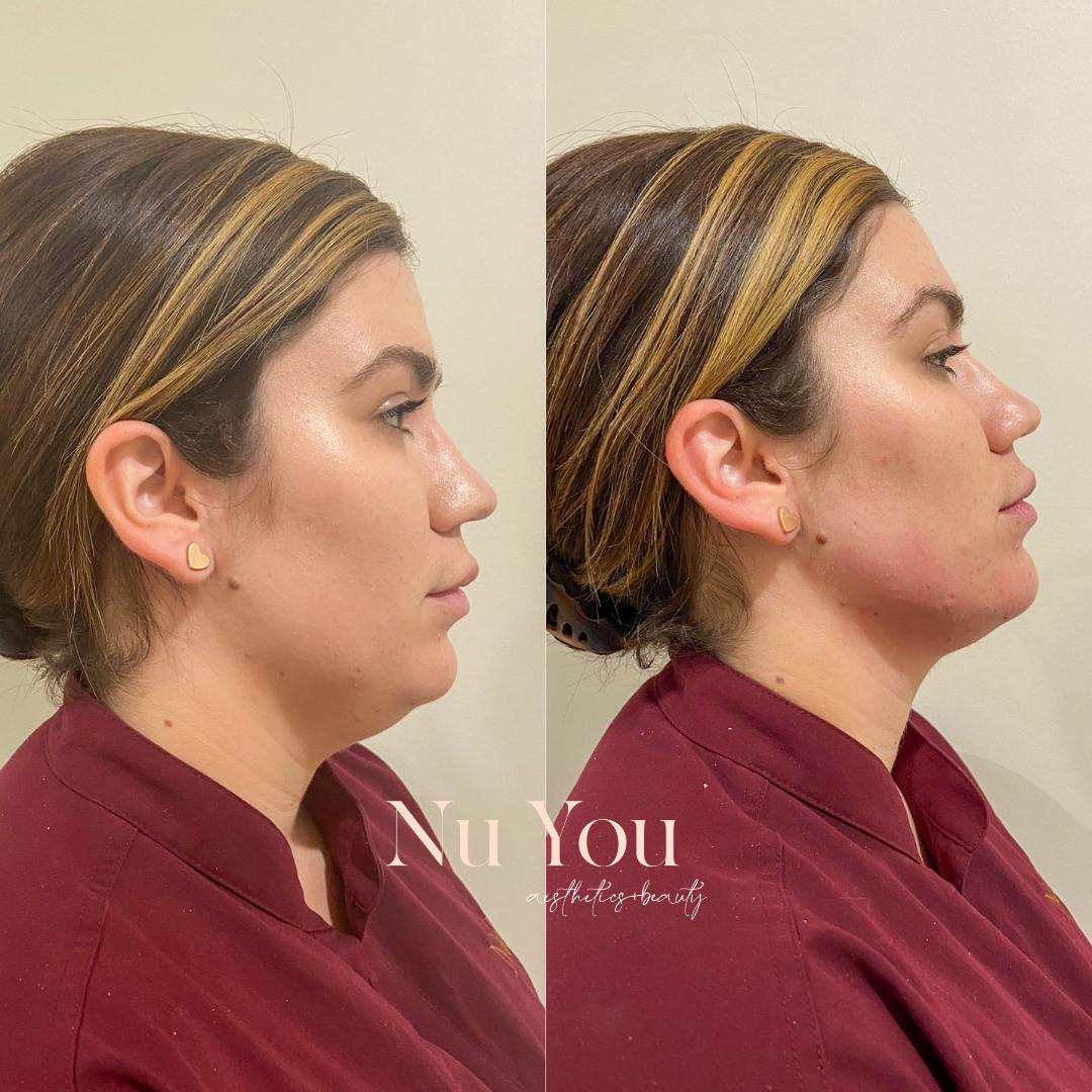 Fat Dissolver by Nu You Aesthetics & Beauty Clinic Mackay