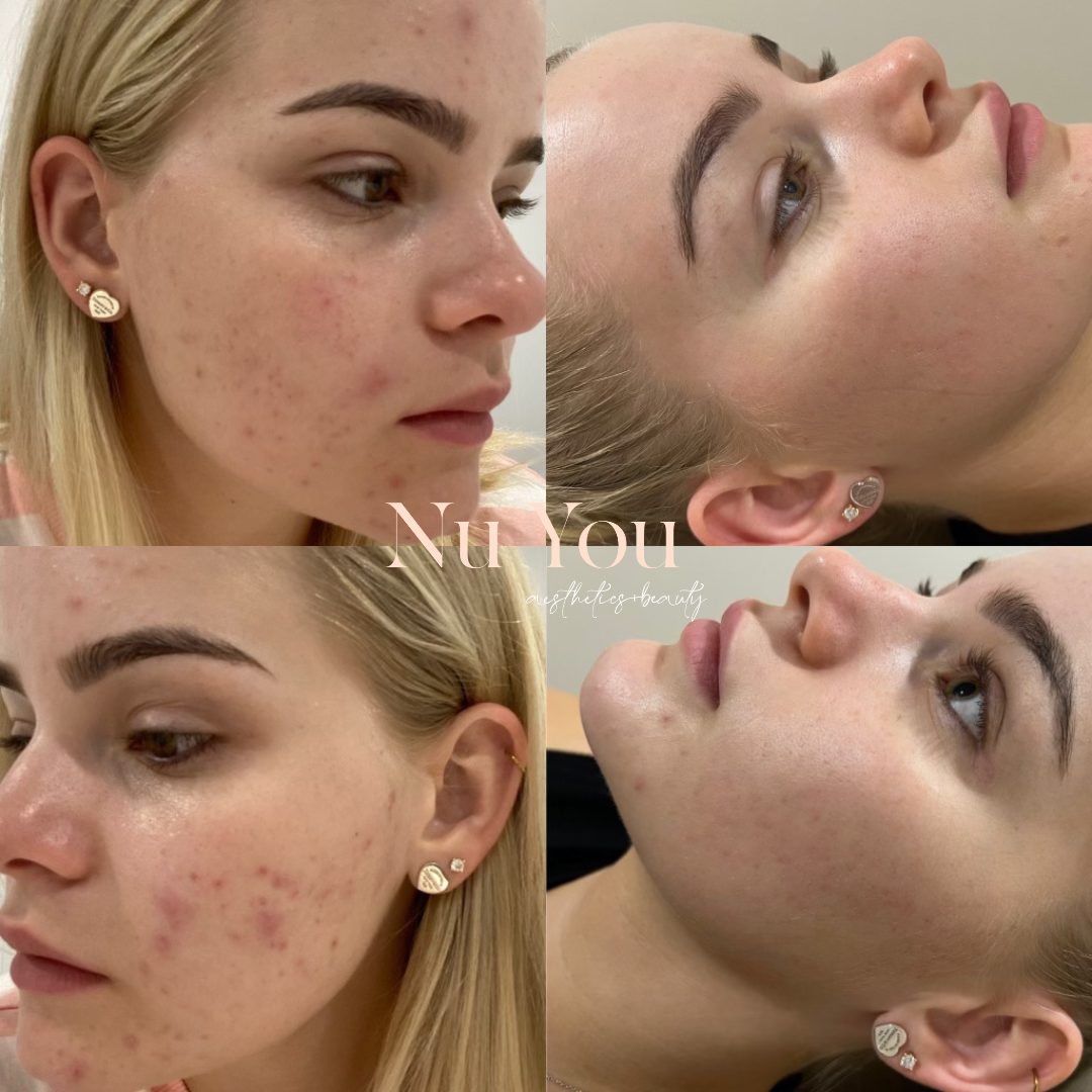 skin needling by Nu You Aesthetics & Beauty Clinic Mackay