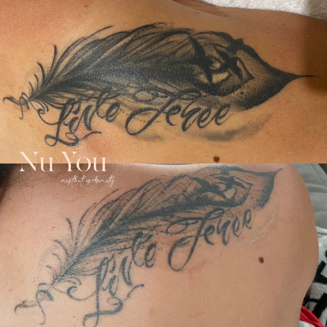 Laser Tattoo removal by Nu You Aesthetics & Beauty Clinic Mackay