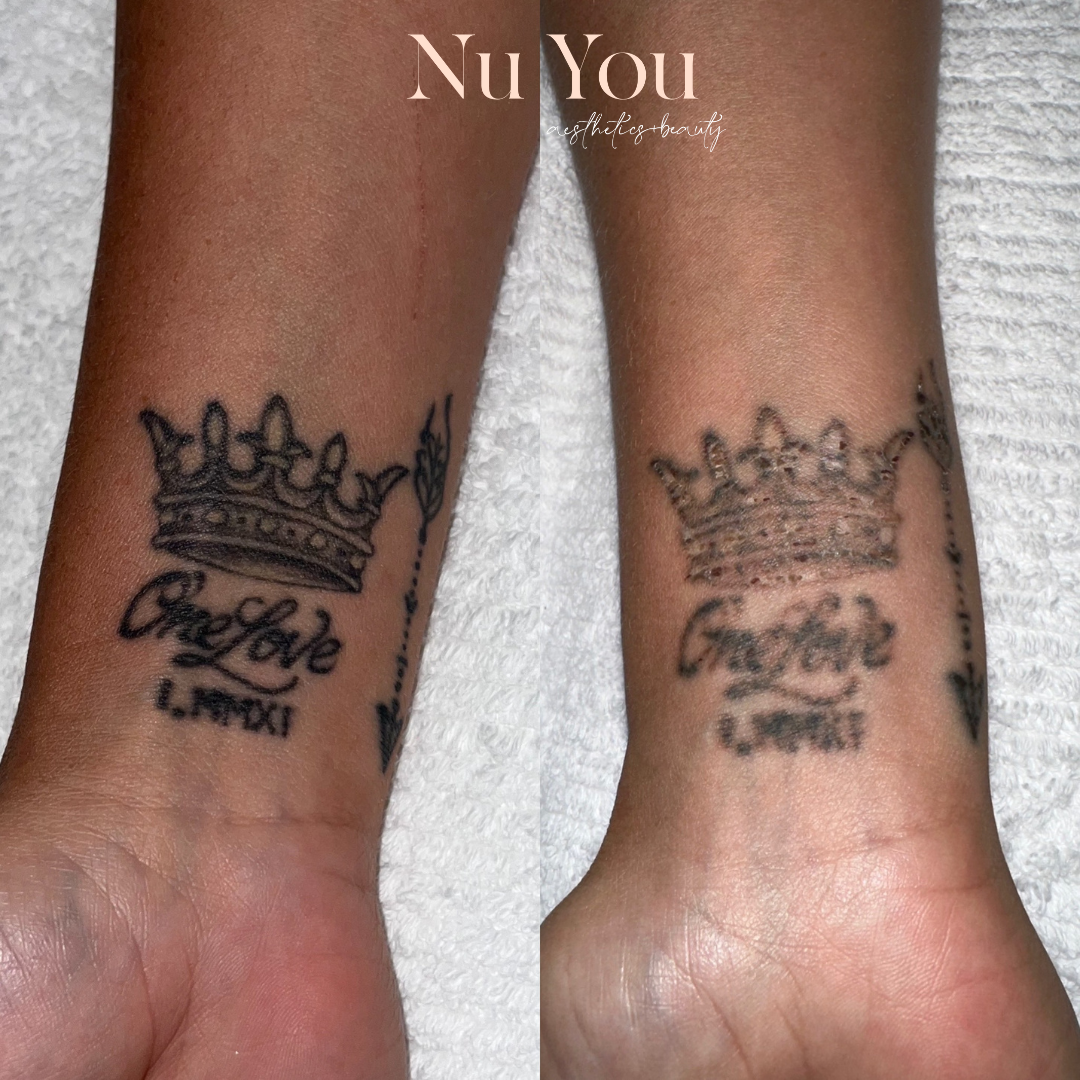 tattoo removal by Nu You aesthetics & beauty clinic Mackay