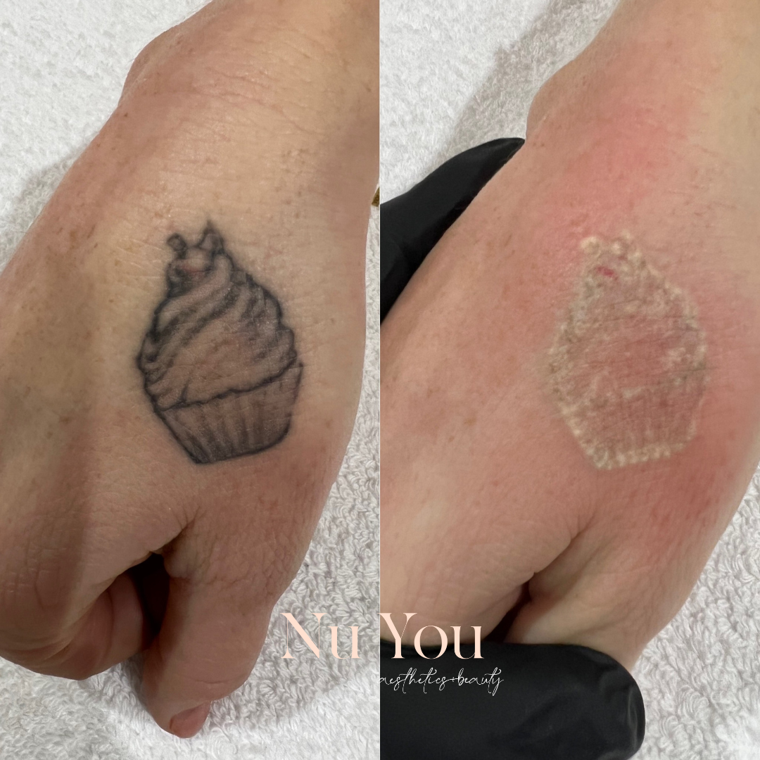 laser tattoo removal by Nu You aesthetics & beauty clinic Mackay